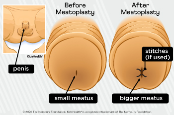 baby with penis before and after meatoplasty