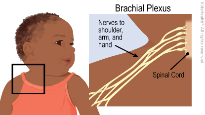 Diagram shows the brachial plexus nerves inside the body extending from the spinal cord towards the shoulder, arm, and hand.