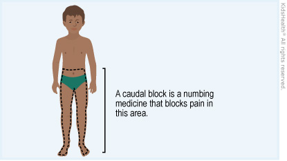 Illustration: caudal block