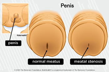 infant penis with and without meatal stenosis