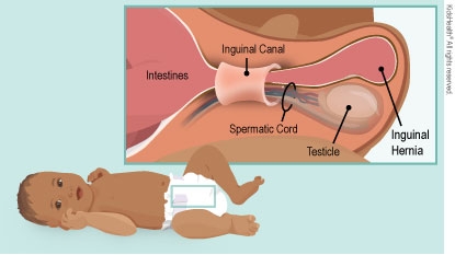 An inguinal hernia with intestines going through the inguinal canal next to the spermatic cord and testicle.