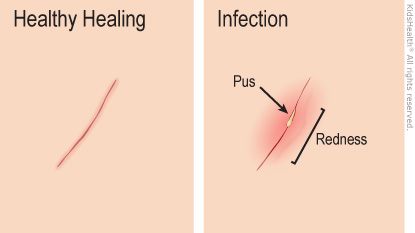 Illustration: healthy healing compared to infection showing pus and redness