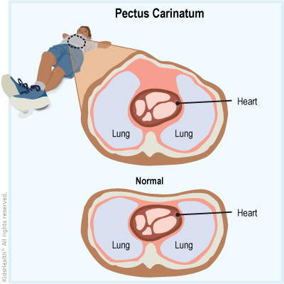 Illustration: Pectus Carinatum showing the heart and lungs inside of the ribcage.