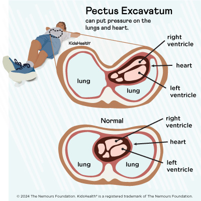 Pectus excavatum can put pressure on the heart and lungs.