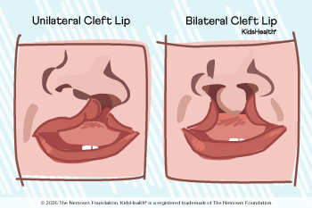 unilateral cleft lip and bilateral cleft lip