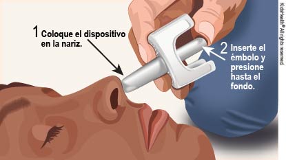 Persona inconsciente acostada sobre la espalda con la cabeza inclinada hacia atrás. La punta del dispositivo de plástico se coloca en el orificio nasal de la persona. El siguiente paso es presionar el émbolo para administrar el aerosol nasal Narcan.