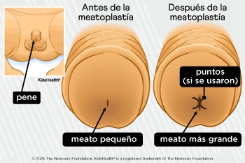Pene de un niño antes y después de la meatoplastía