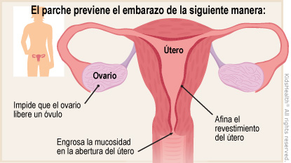 El diagrama muestra el sistema reproductor femenino y explica cómo funciona el parche para prevenir el embarazo, según lo indica el texto.