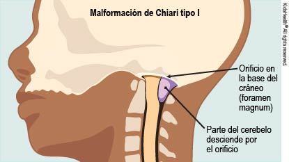 La ilustración de la malformación de Chiari tipo I muestra el orificio en la base del cráneo (foramen magnum) y parte del cerebelo que desciende por este.