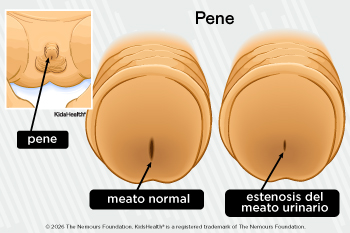 Pene infantil con y sin estenosis del meato
