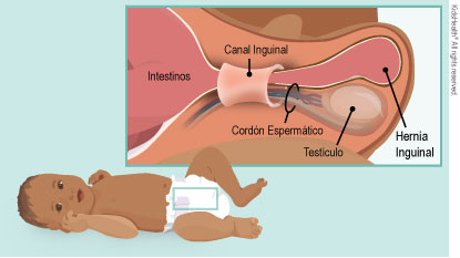 Se muestra una hernia inguinal con los intestinos que pasan por el canal inguinal junto al cordón espermático y el testículo.