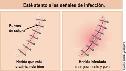 Se muestra una herida con puntos que cicatriza bien y una herida infectada con enrojecimiento y pus alrededor de los puntos. Esté atento a signos de infección.