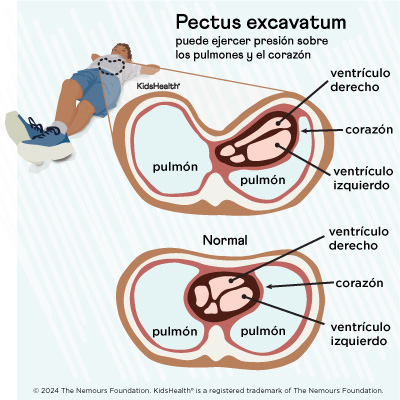 Presión del pectus excavatum en el corazón y los pulmones.