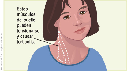 Illustration: torticollis